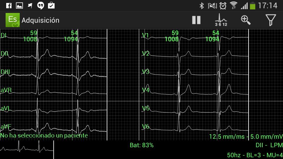 ElectroSmart ECG